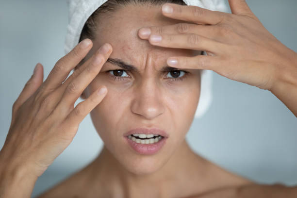 How stress affects skin